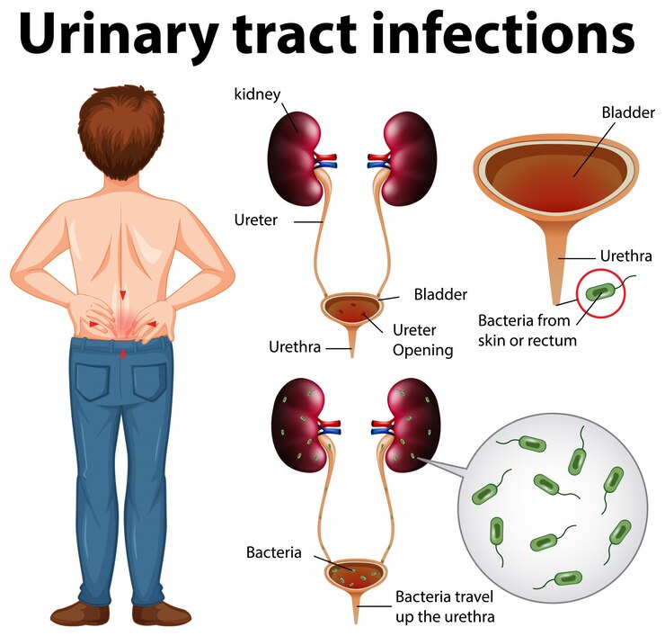 Urinary Tract Infections in Children